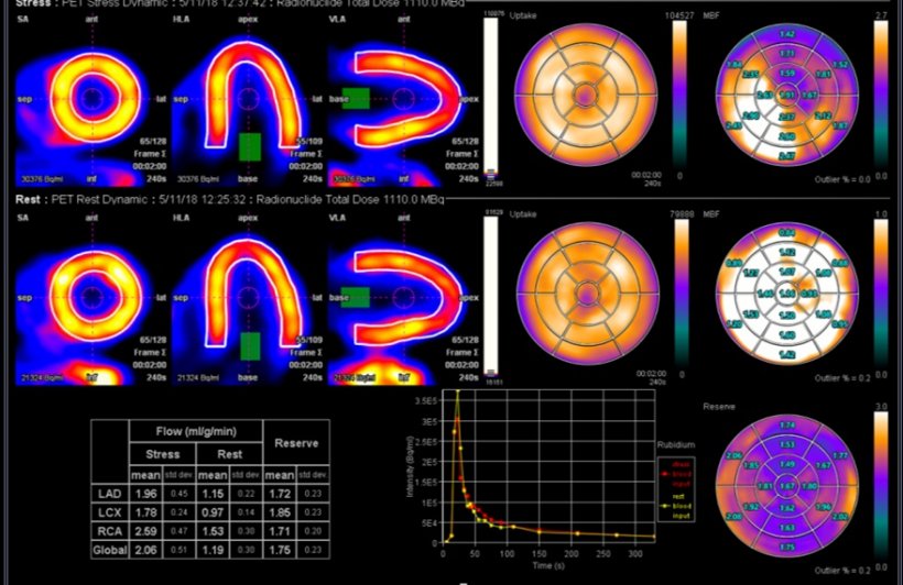 Quantitative Myocardial Perfusion Reserve with Rb-82 PET