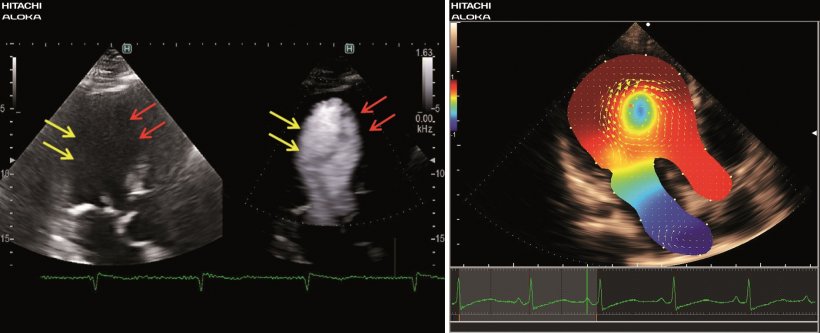 Left: LV eFlow – technically difficult patient; right: VFM – relative...