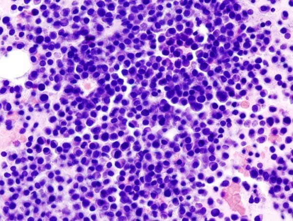 A simple blood tests could improve diagnosis of myeloma