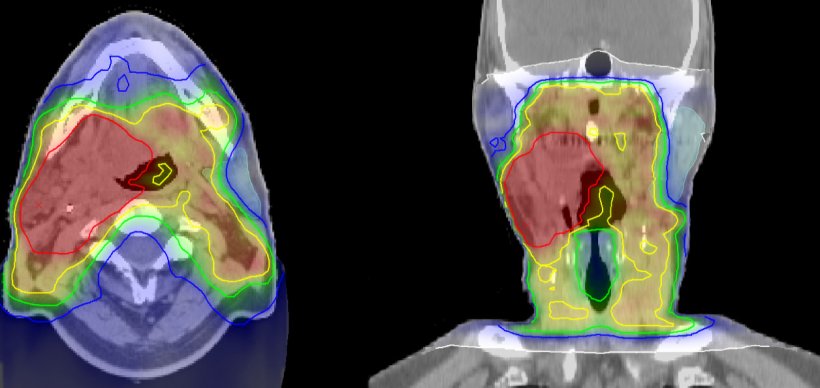 Irradiation plan of head and neck cancer
