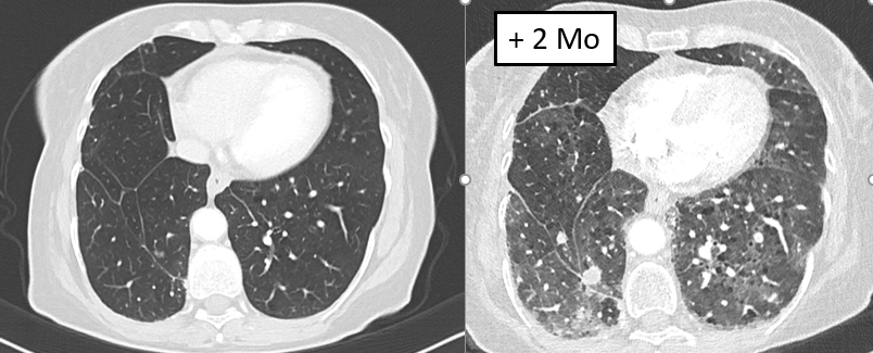 Pulmonale Toxizität: Toxische Alveolitis unter Nivolumab