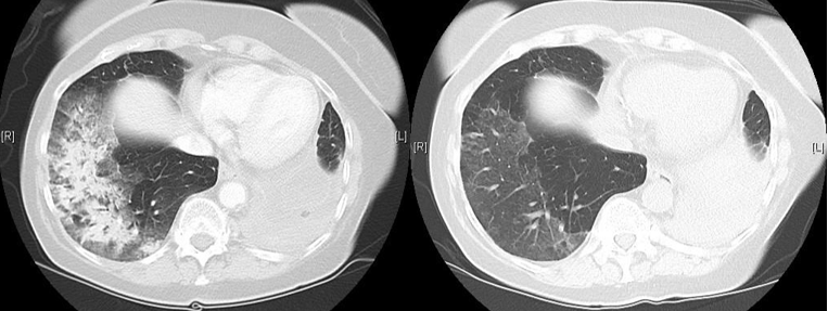 Pulmonale Toxizität: COP unter Nivolumab vor (links) und 4 Wochen nach Beginn...