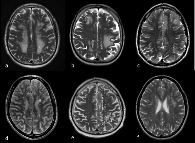 a: konfluierende mikroangiopathische Läsionen (Fazekas 3), b: Metastasen, c:...