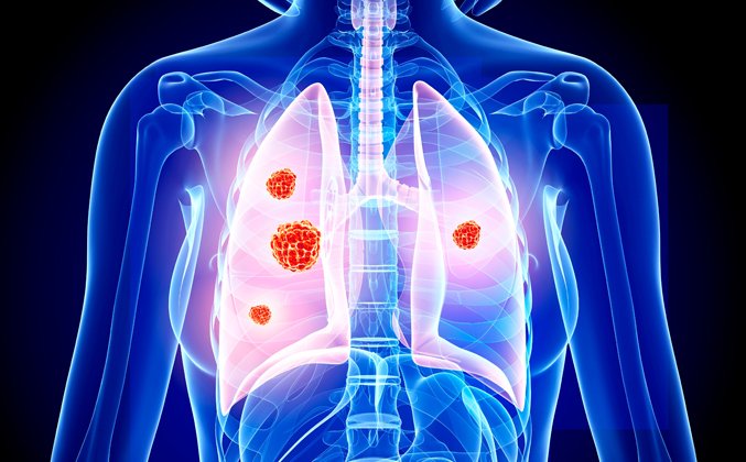 Women with non-small cell lung cancers live longer than men