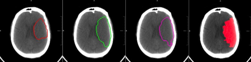 Example of deep learning to predict thrombectomy outcome in acute stroke based...