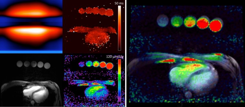 Sodium mapping of the heart using 7 Tesla MRI: Higher signal-to-noise ratio...