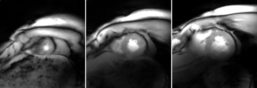 High-resolution Simultaneous Multi-Slice (SMS) dynamic MRI of the heart at 7...