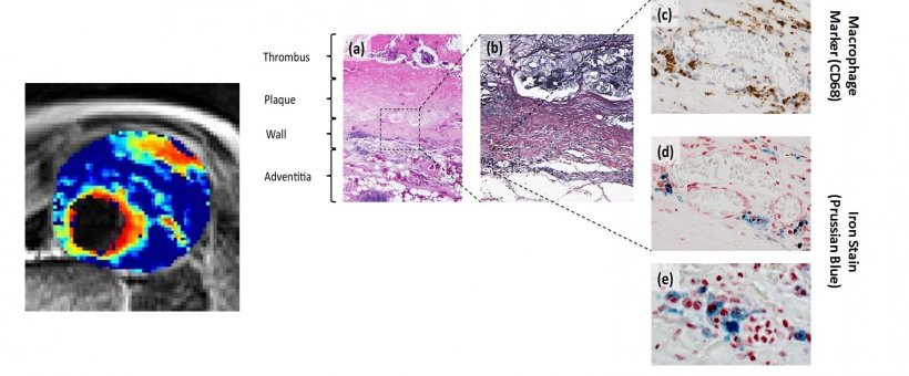 USPIO Imaging T2* Maps