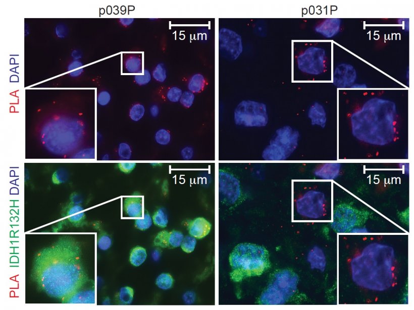 Brain tumour cells producing the mutated protein molecule IDH1R132H (green)...