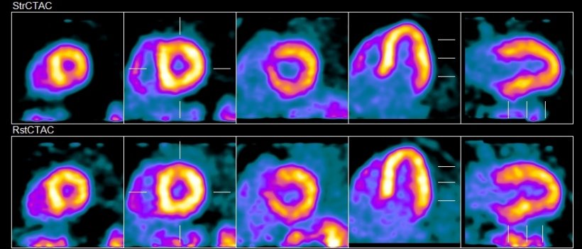 Vereos PET/CT study performed with RB-82 Chloride to classify the state of...