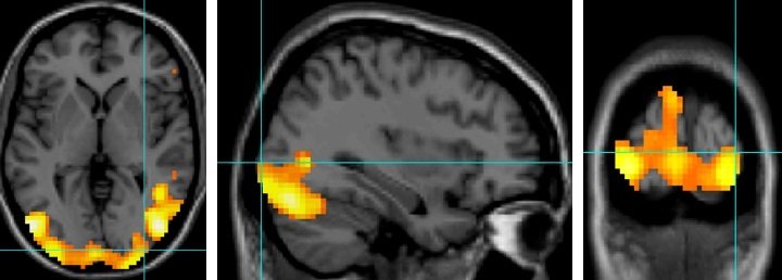 fMRI imaging of activated visual cortex in the human brain
