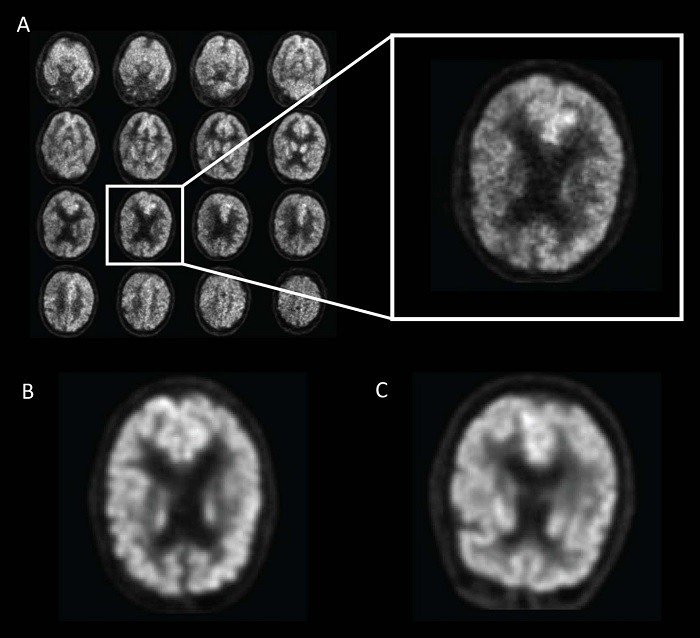 Example of fluorine 18 fluorodeoxyglucose PET images from Alzheimers Disease...