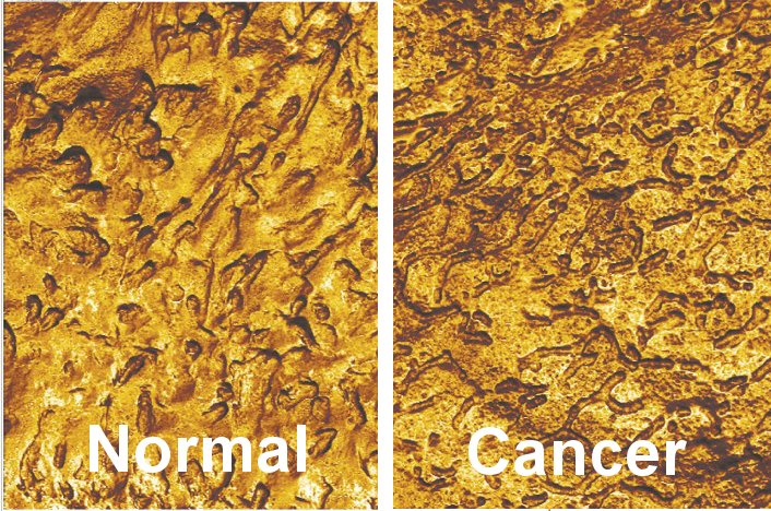 Cell surface adhesion properties of normal (left) vs cancer cell (right)...