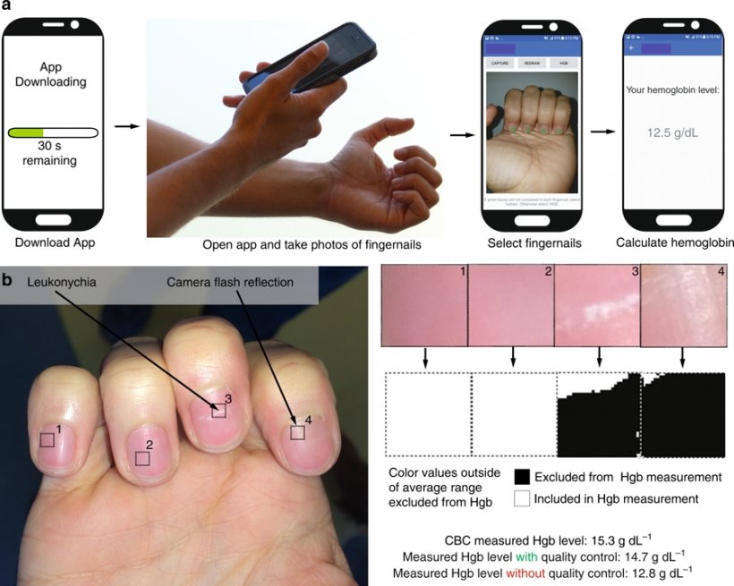 Die App der Forscher wandelt Fotos von Fingernägeln in eine Anämie-Diagnose...