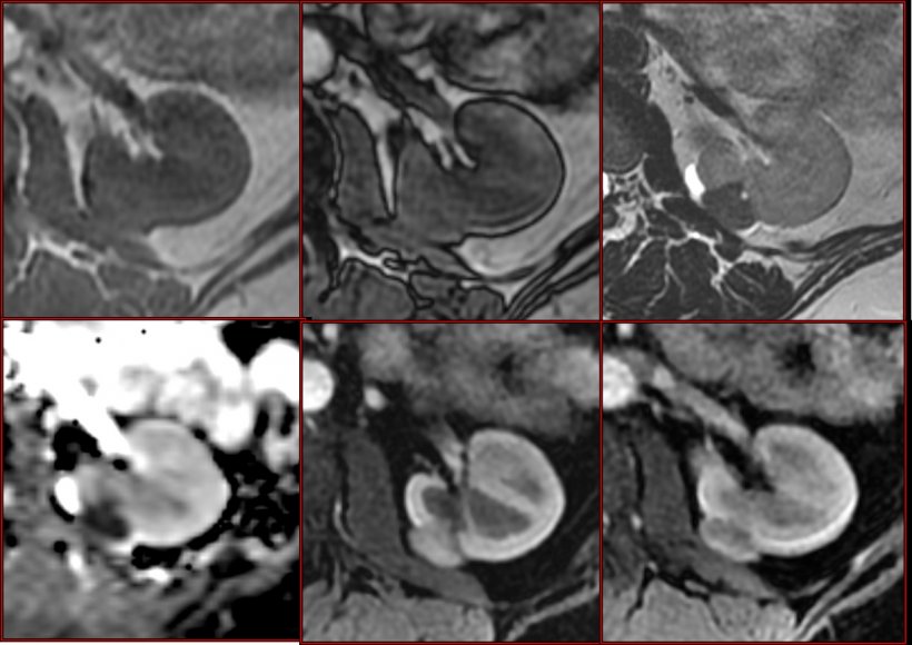 Example of mpMRI of kidney tumours: Diagnosis of poor-fat angiomyolipoma is...