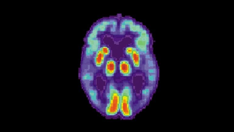A PET scan of the brain of a person with Alzheimer’s disease.