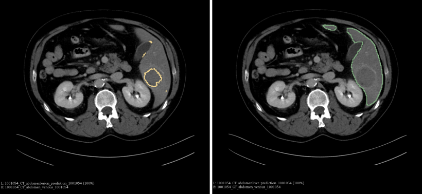 Tumor-Segmentierung (links) und Segmentierung der gesamten Leber.