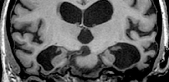 MRI brain scan of patient with dementia
