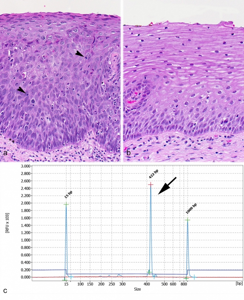 a) Histology of severe epithelial dysplasia (carcin-oma in situ) of the...