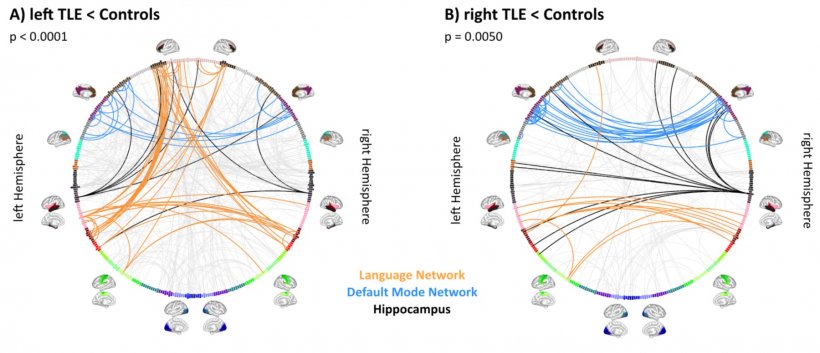 The changed connectome in patients with epilepsy of the left temporal lobe....