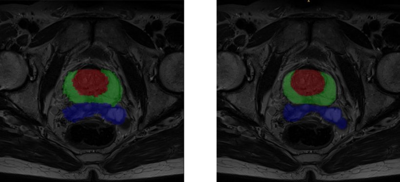 The Quibim image analysis platform uses deep supervision to generate output...