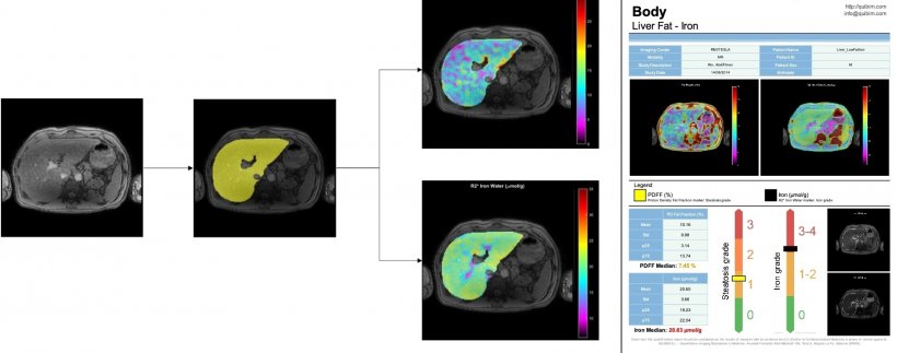 Segmenting the liver on MRI, the QUIBIM software can separate proximal vessels...