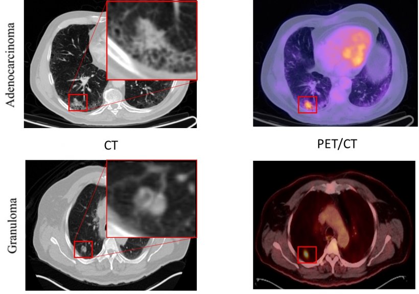 Adenocarcinomas and granulomas present a significant radiographic challenge...