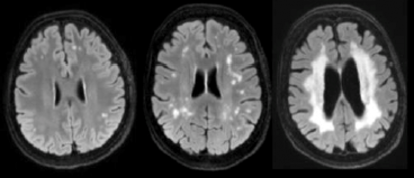 Microangiopathy, Fazekas score
from left: initial, beginning to confluate,...