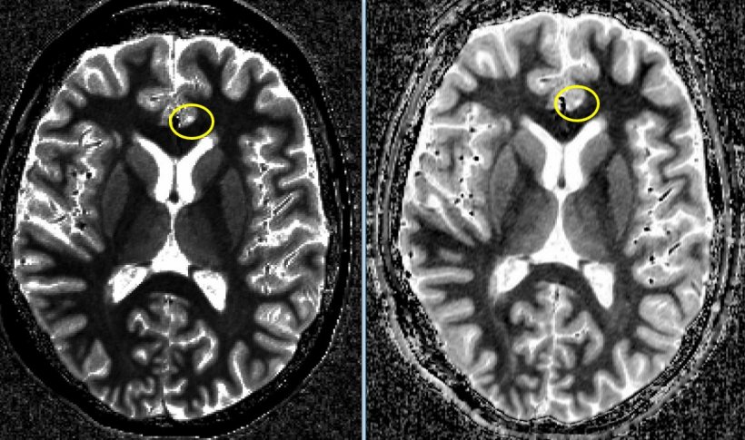 Cortical lesions in 7T-MRI
