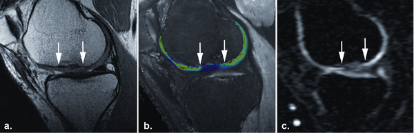 Sodium cartilage transplant: a morphological MR image of a cartilage transplant...