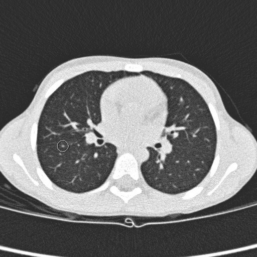 Small pulmonary nodules in children with rhabdomyosarcoma do not behave like...