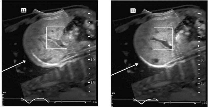 The left image is without respiratory compensation, which adds an artifact...