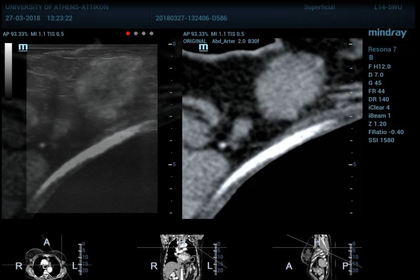 To the left, the fused image of US and CT for a lymph node prior to biopsy. To...