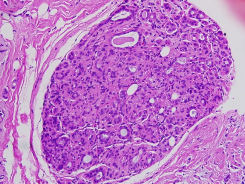 Histopathologic image from ductal cell carcinoma in situ (DCIS) of the breast.