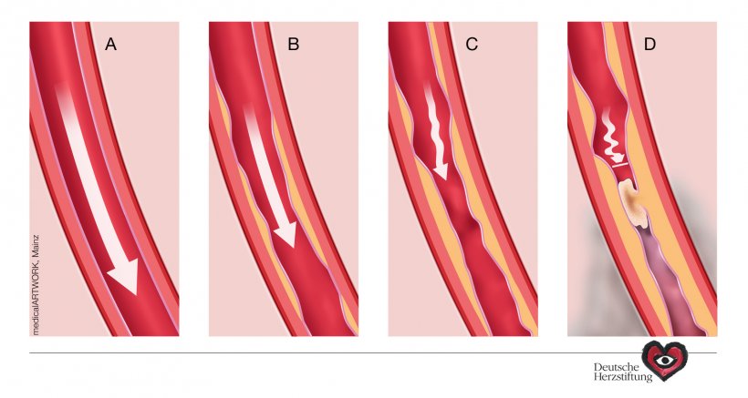 A: Gesunde Arterie, das Blut fließt ungehindert
B: Die Arteriosklerose führt...