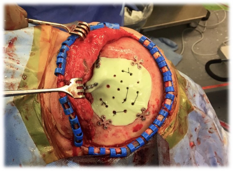 Intraoperative view of an hybrid cranioplasty implant in situ.
