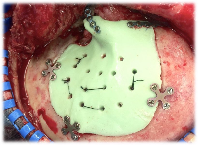 Intraoperative view of an hybrid cranioplasty implant in situ