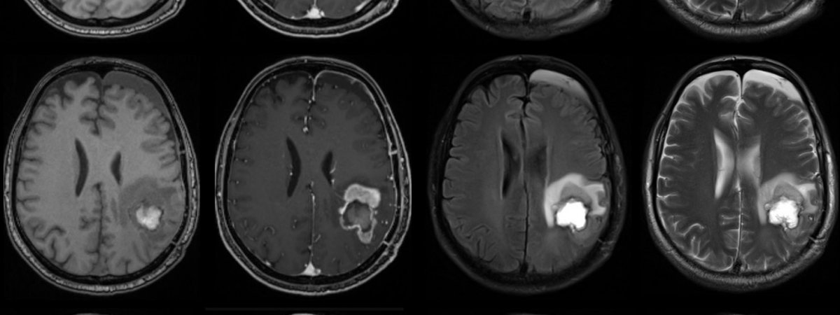 Hirntumoren Ki Erkennt Welche Therapie Wirkt