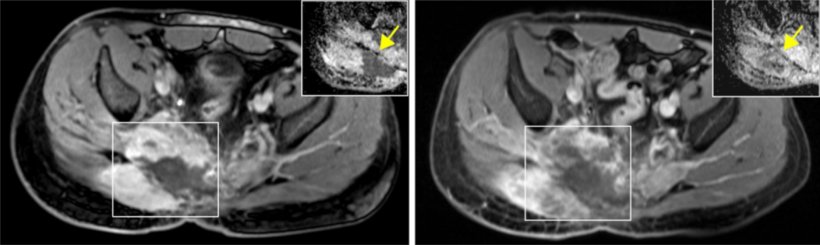 Left: patient with advanced-stage chordoma; right: cessation of tumor growth...