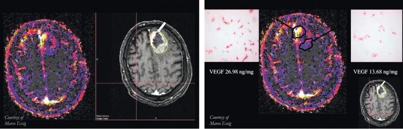 DCE-MRI for Biopsy Planning
images credit of Prof. Dr. Marco Essig, Department...