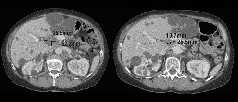 Computed tomography scan of relapsed HGSOC tumor before and after treatment.