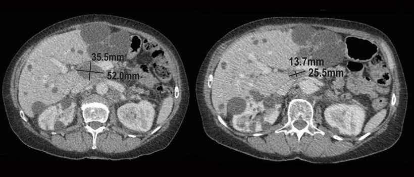 Taking Molecular Snapshots Of Ovarian Cancer Healthcare In Europe Com