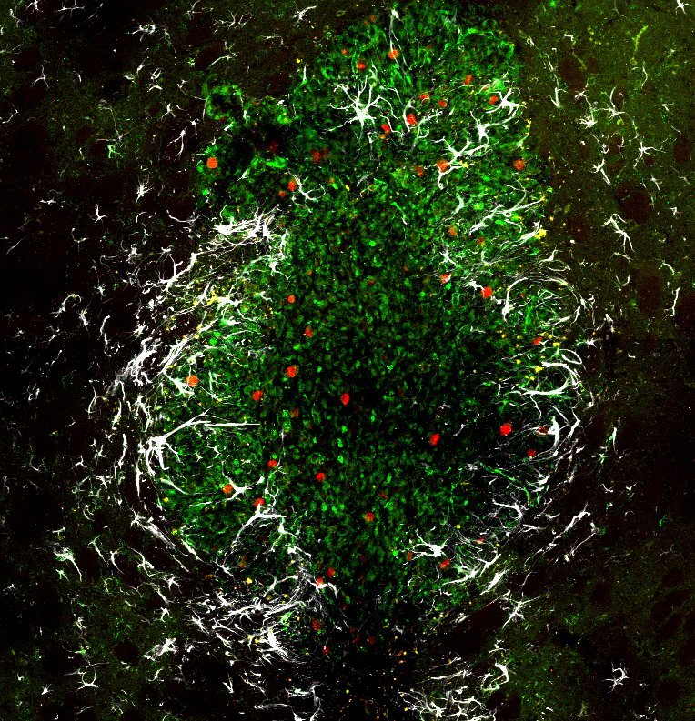 Glioblastom im Gehirn einer Maus: Grün dargestellt sind die Tumorzellen, rote...