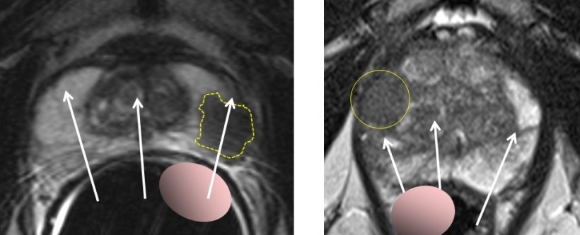 Left: Prostate cancer in the peripheral zone, palpable with digital rectal...