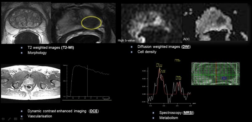 Multiparametric MRI (mpMRI) of the prostate