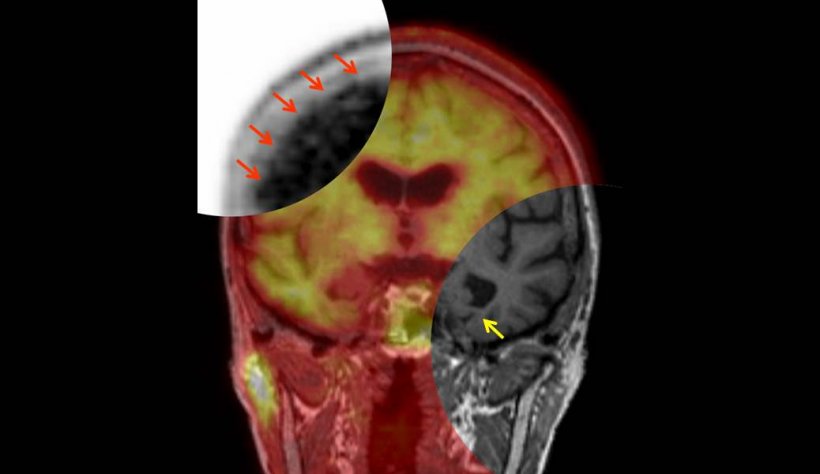 Amyloid-PET/MRT bei Alzheimer-Krankheit. Die roten Pfeile zeigen die...