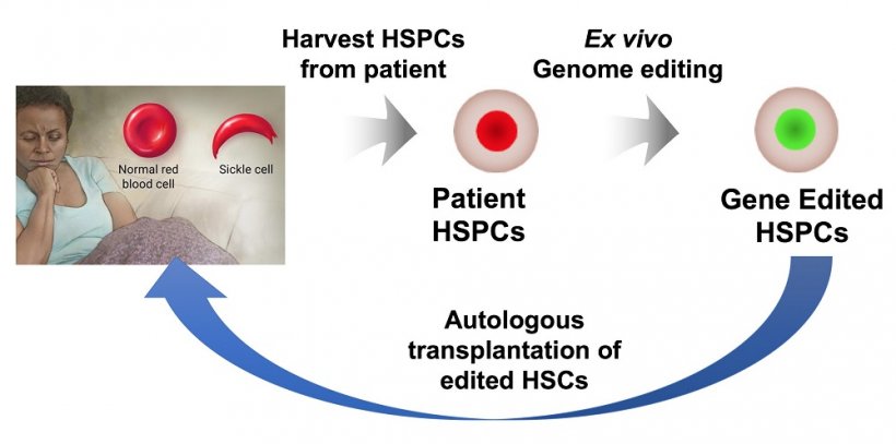 An illustration shows the process by which a patients own hematopoietic stem...