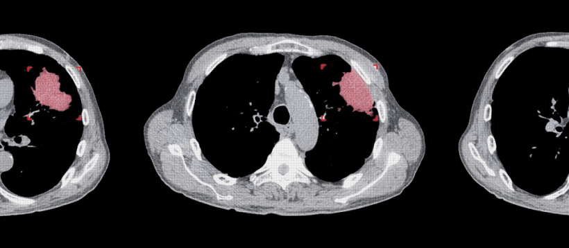 Computer aided detection will utilize intelligence in detecting lesions...
