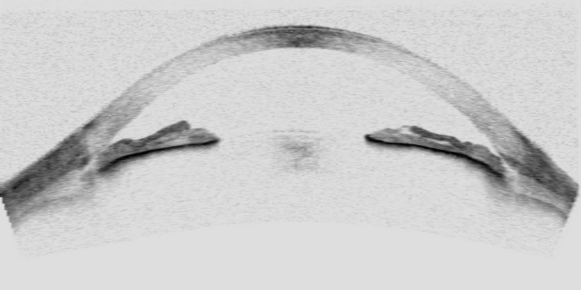 Detail of the iridocorneal angle of an eye.