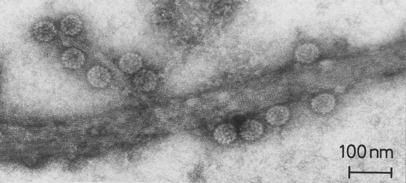 Papillomavirus from skin wart under transmission electron microscopy. Negative...